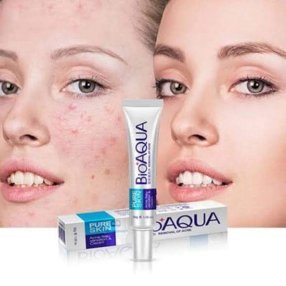 Bioaqua 30g Acne Treatment Blackhead Removal Cream - Neozen Store