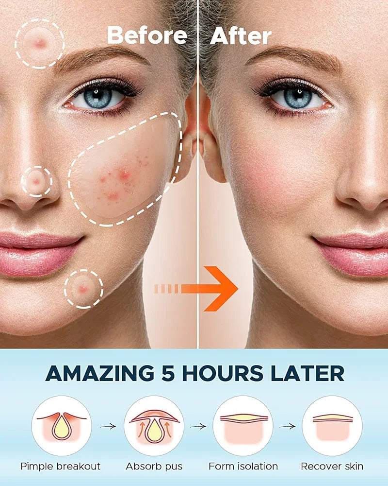 ✨ Invisible Acne Pimple Patches – Fast Spot Treatment & Oil Control (72 Patches Pack)
