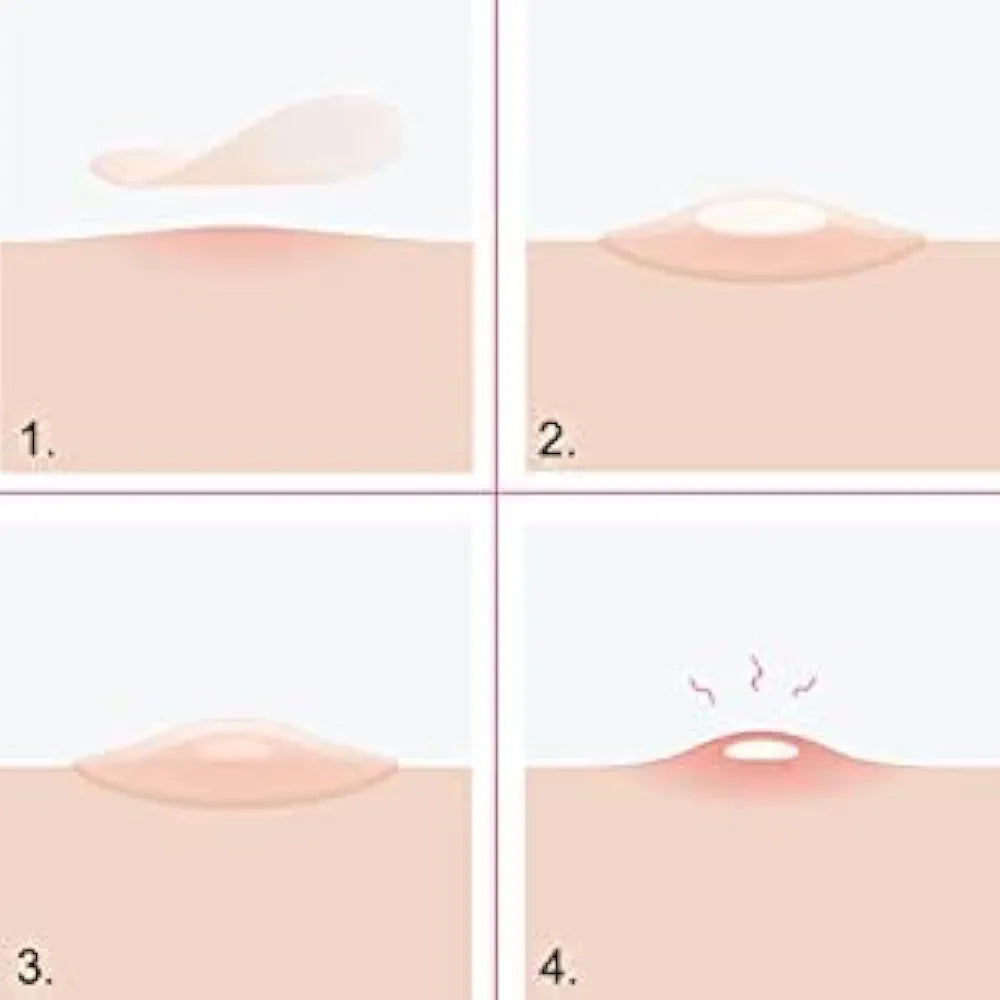 ✨ Invisible Acne Pimple Patches – Fast Spot Treatment & Oil Control (72 Patches Pack)